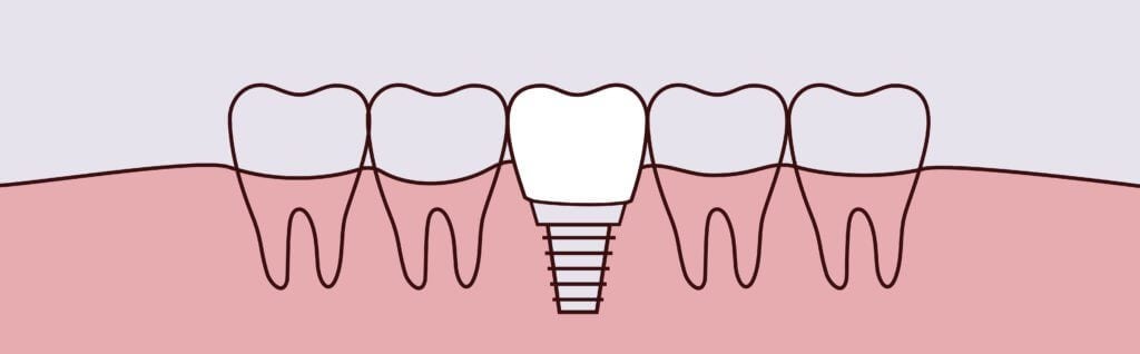 dental implants Sacramento